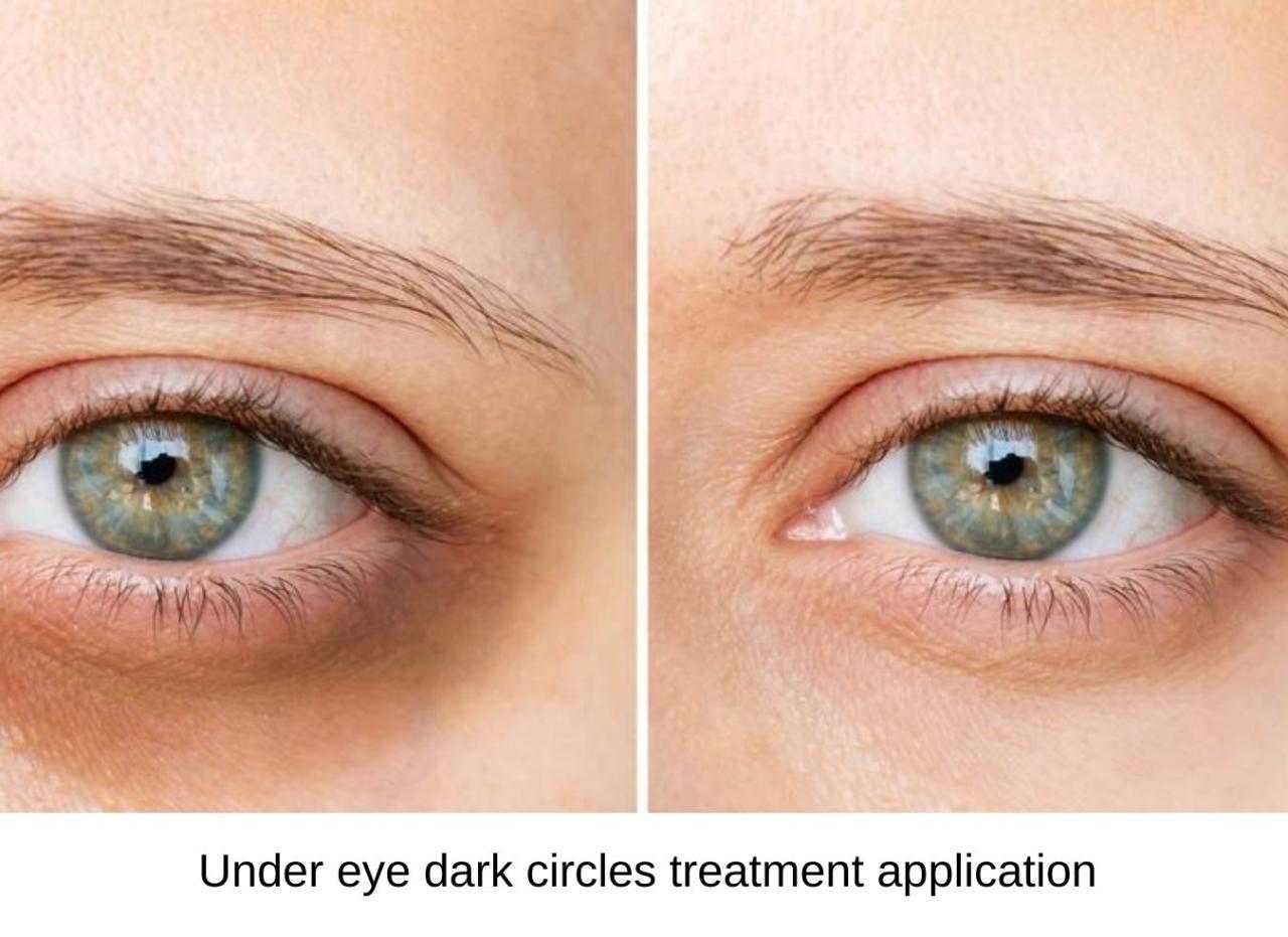 Dark Circles Under Eyes - Clinic National How To Prevent And Treat Dark Circles Under Eyes